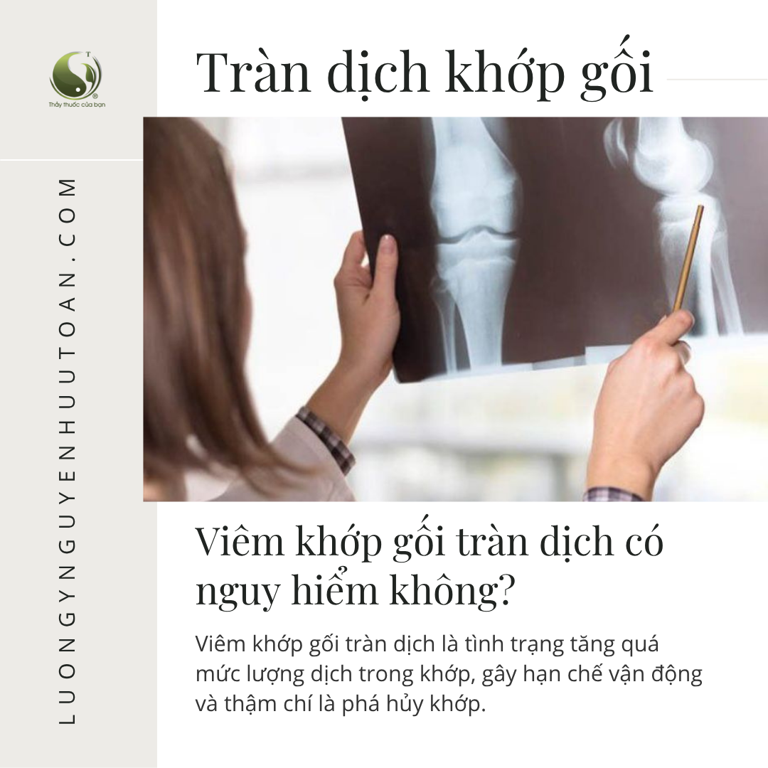 HẾT TRÀN DỊCH KHỚP GỐI - KHÔNG HÚT DỊCH