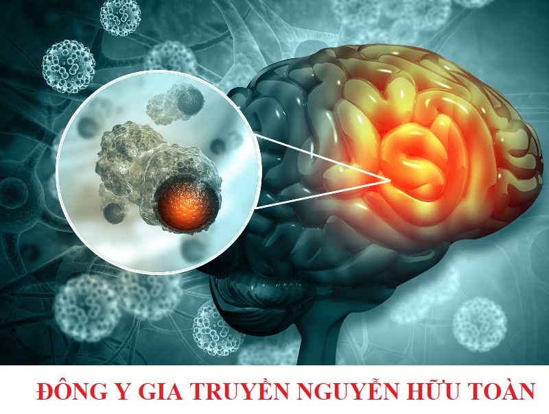 CƠ HỘI CHO NGƯỜI BỊ U NÃO