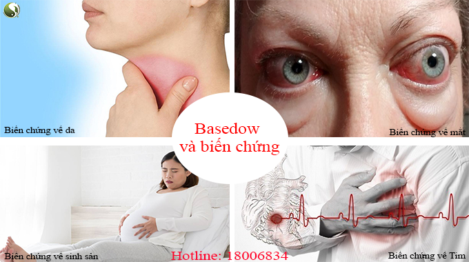 Basedow bien chung