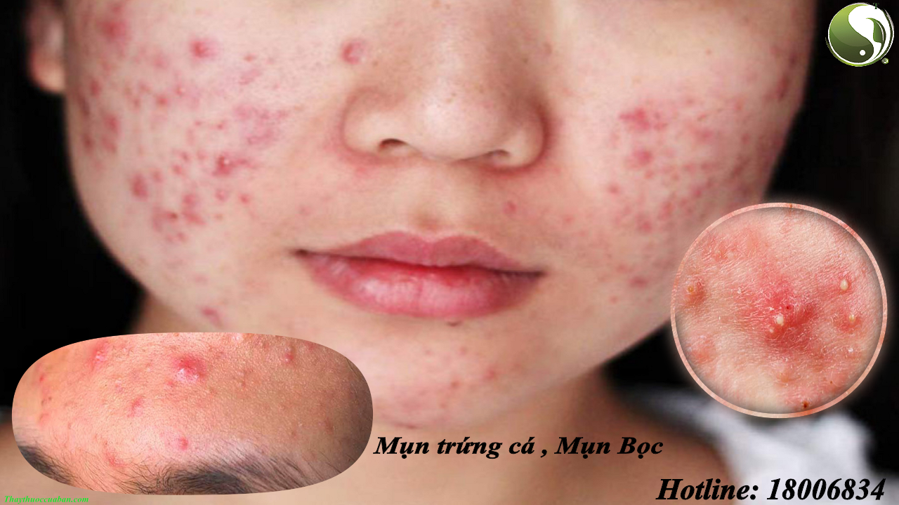 Mụn bọc, mụn trứng cá