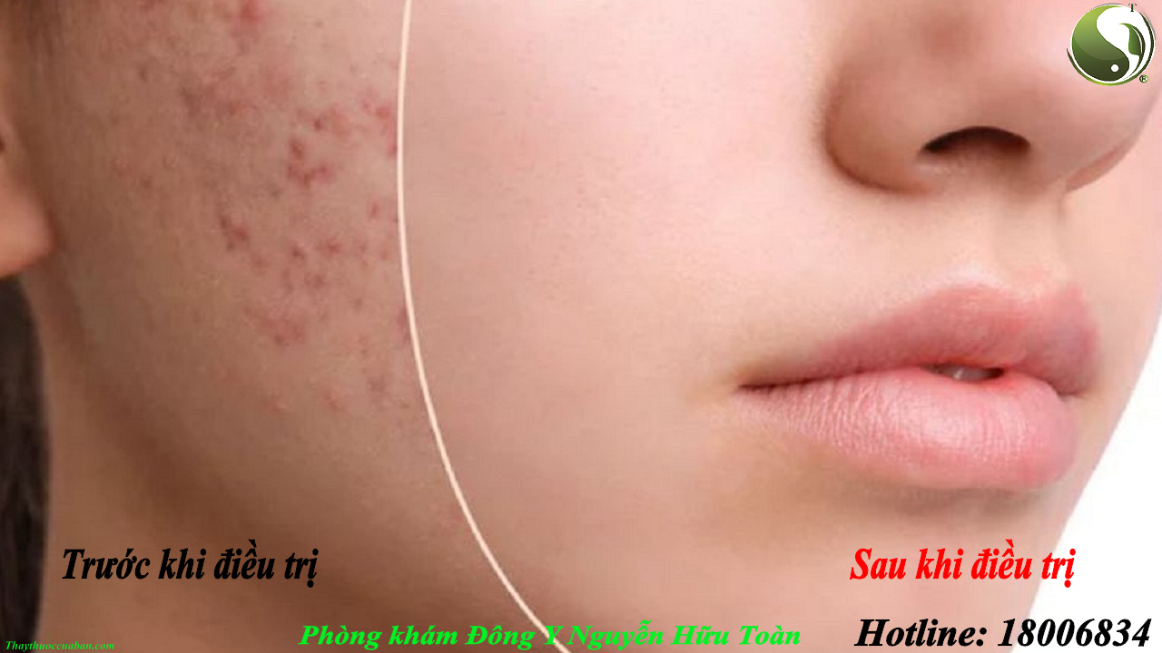 Mụn bọc, mụn trứng cá