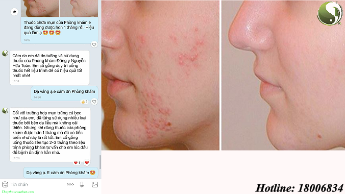 Mụn bọc, mụn trứng cá