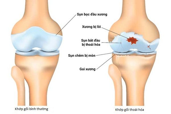 Thoái hóa xương khớp