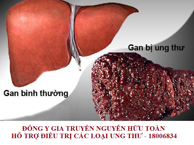 Đông y chữa ung thư gan